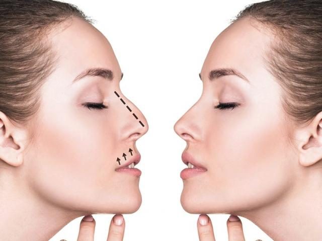 Rhinoplasty Surgery