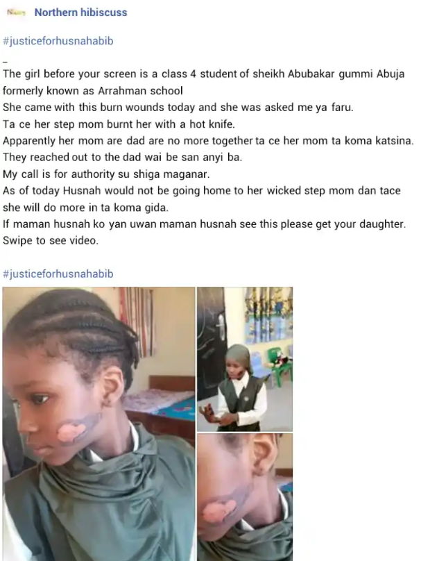Violence: Stepmother Reportedly Burns Girl's Face in Abuja 2 Justice For Girl