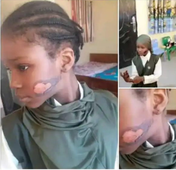 Violence: Stepmother Reportedly Burns Girl's Face in Abuja 1 Stepmum Burns Girl's Face