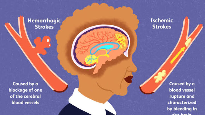 Signs of stroke